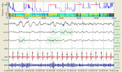 Screenshot of PRANA in Polysomnography